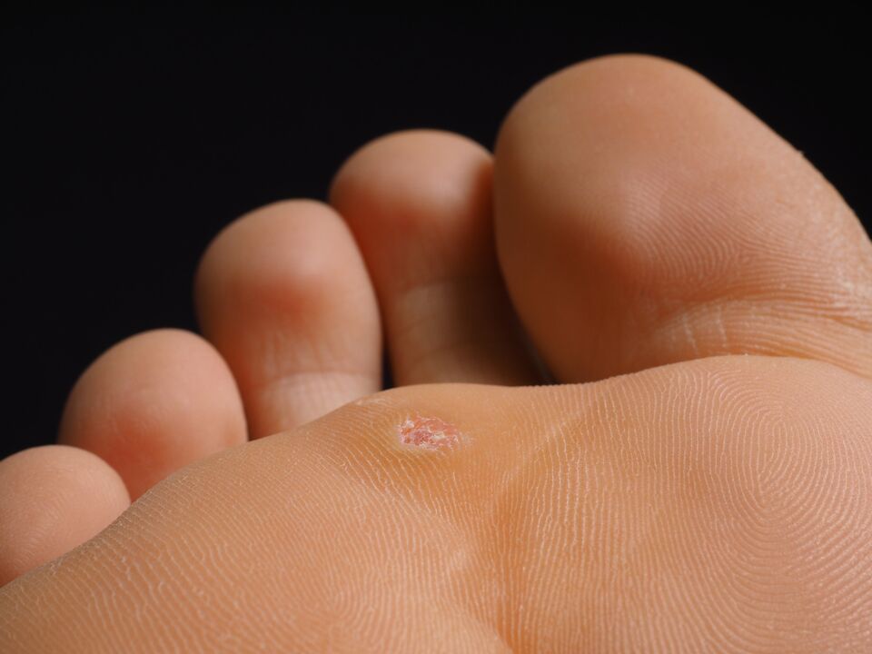 what does the sole wart look like