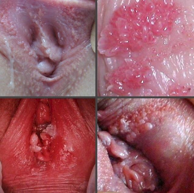 Close up of papillomas in the vagina