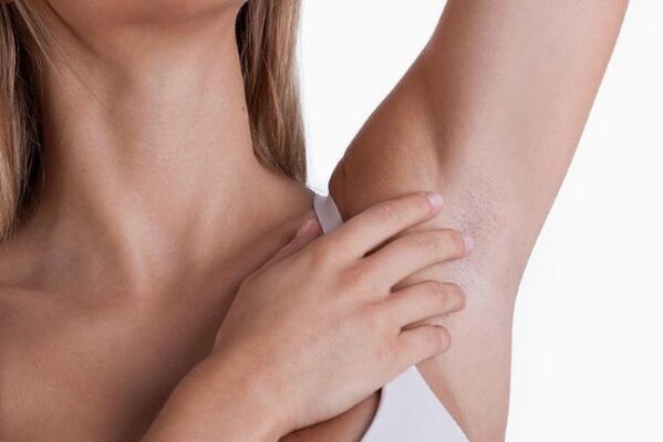 papillomas under a woman’s armpits