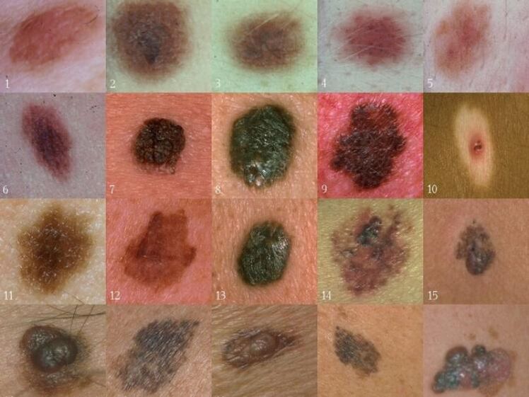 wart types on the skin